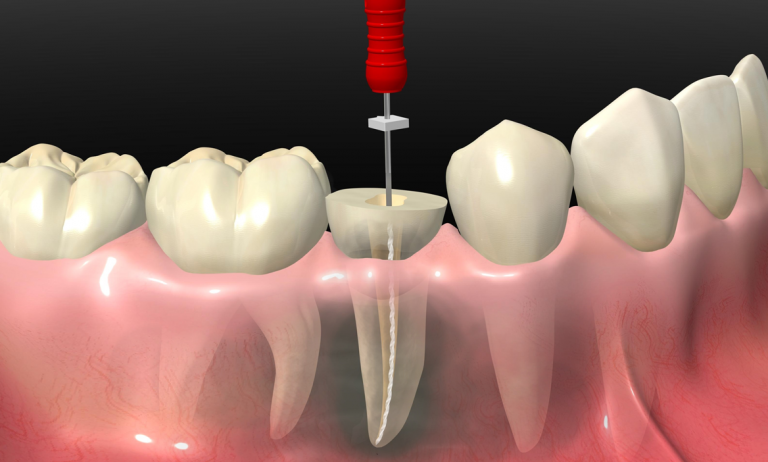 Blog 8 clinica dental reus endodoncia 3