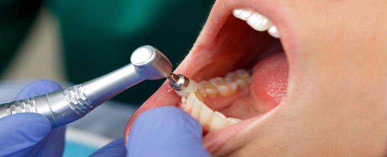 Blog 10 clinica dental reus limpieza 3