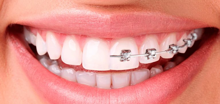 Blog 7 clinica dental reus pina dental 2