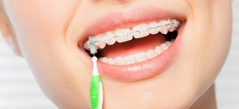 Blog 10 clinica dental reus cepillo interdental 2