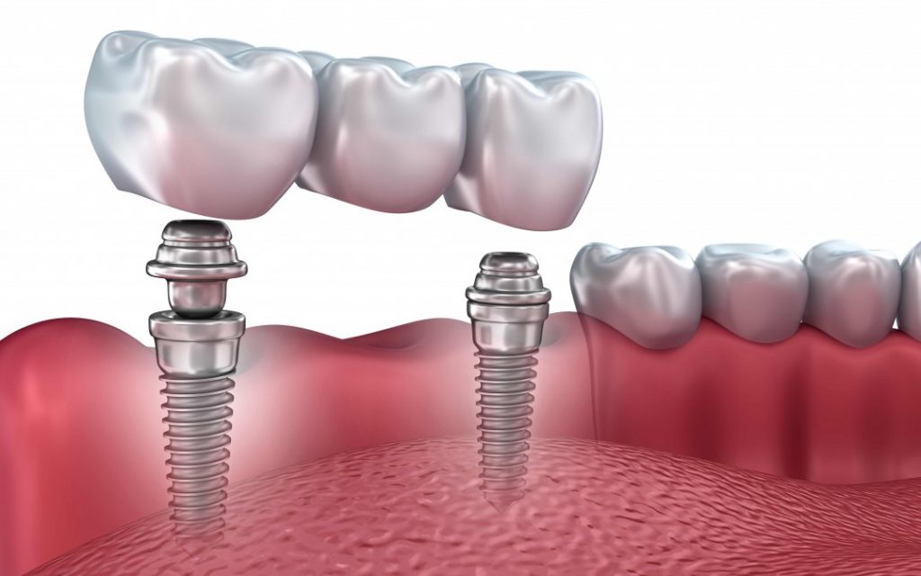 Tipos de implantes dentales 1 clinica dental reus implantes 4