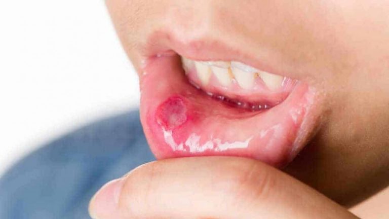 Blog 6 clinica dental reus llagas 2